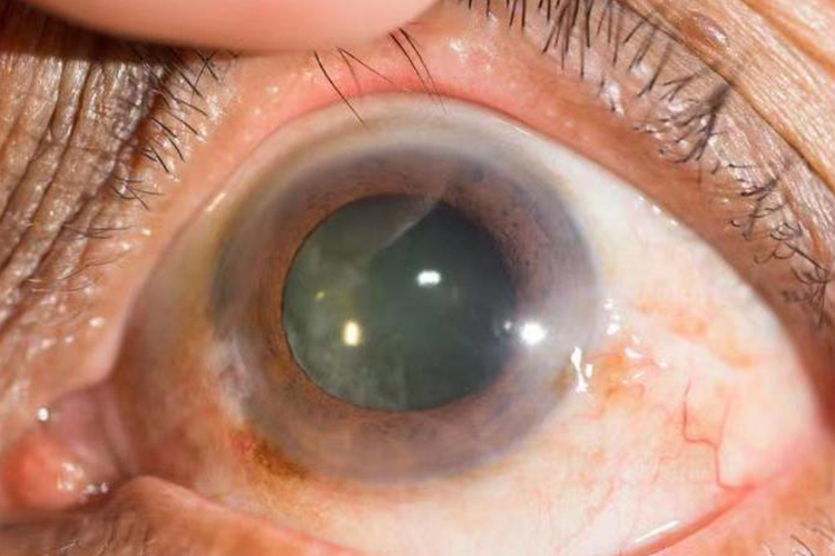 视网膜脱落真实图 视网膜脱落真实图