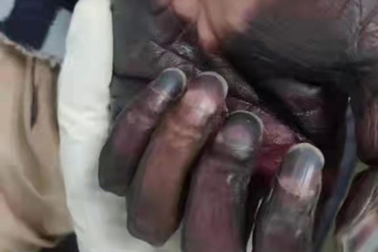 毛霉病手部皮肤发黑图