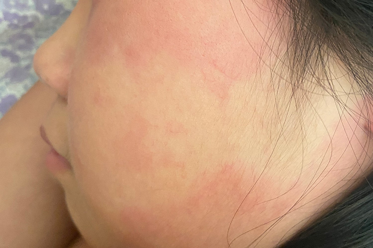 荨麻疹图 荨麻疹图