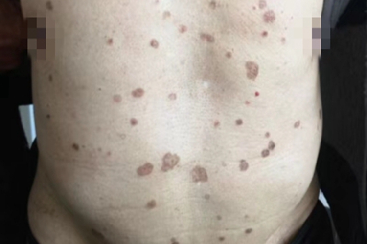 汗孔角化症腹部斑图