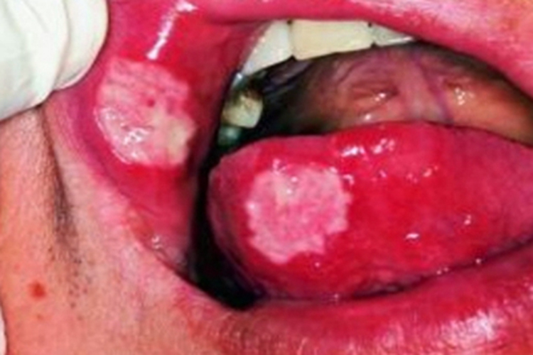 重型复发性阿弗他口腔炎溃疡图 重型复发性阿弗他口腔炎溃疡图