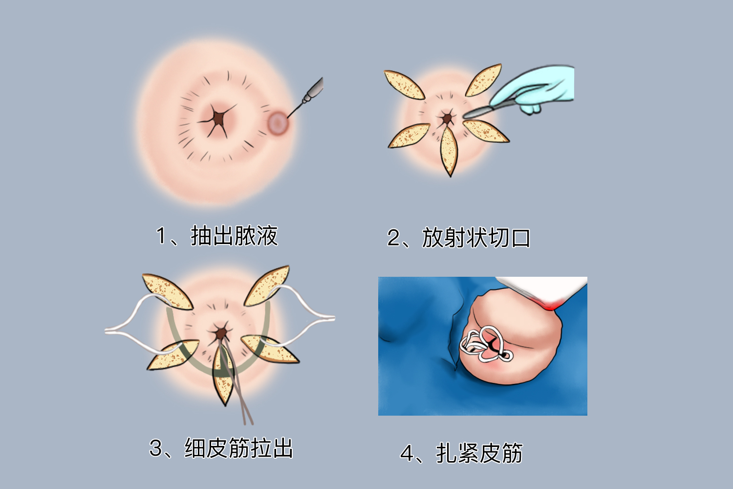 肛周脓肿手术示意图图片