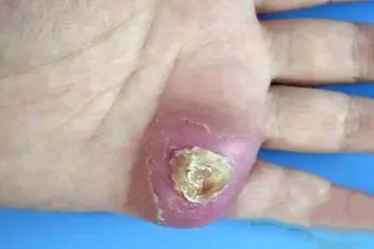 上皮样肉瘤手掌症状图