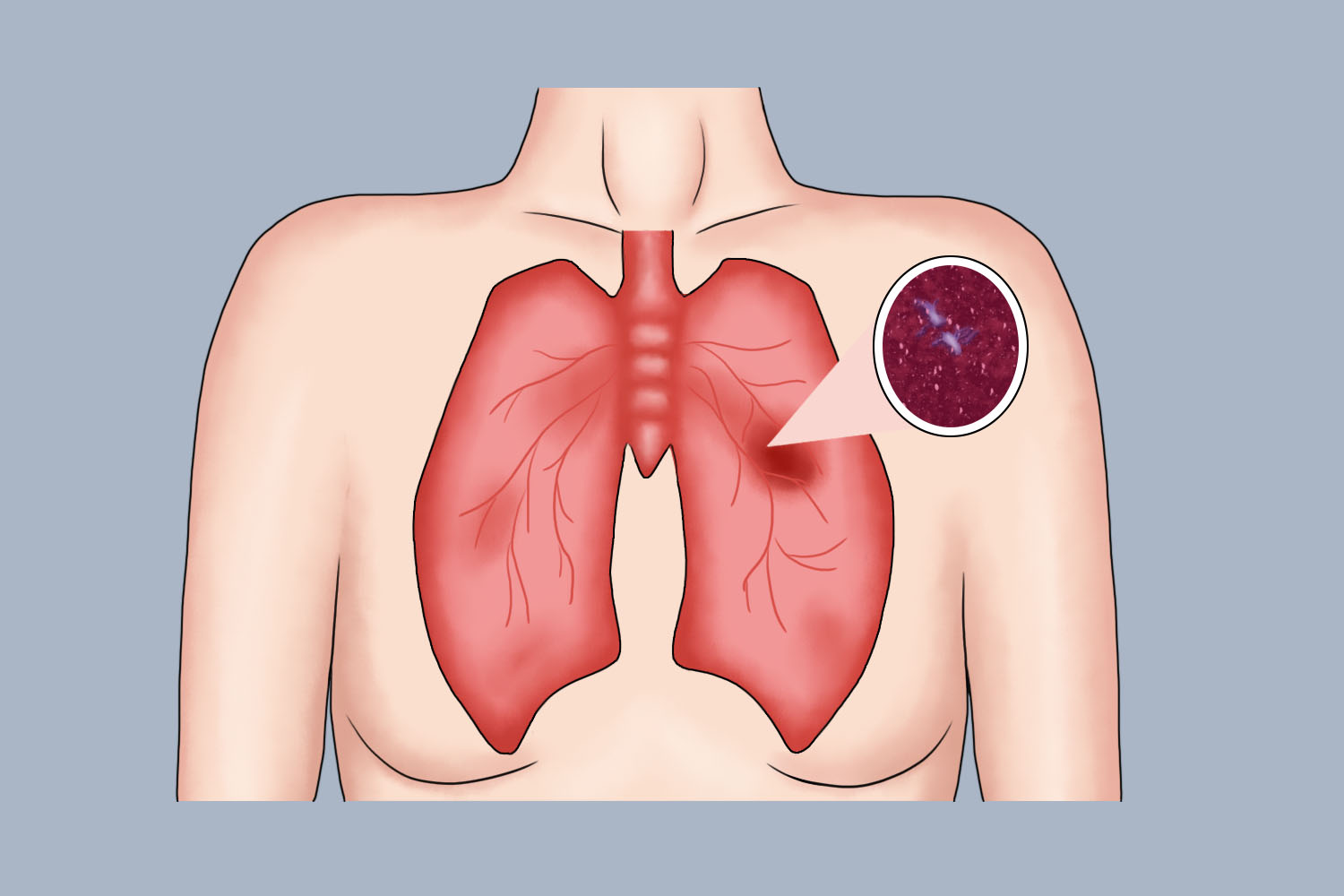 原发性支气管肺癌图 原发性支气管肺癌图