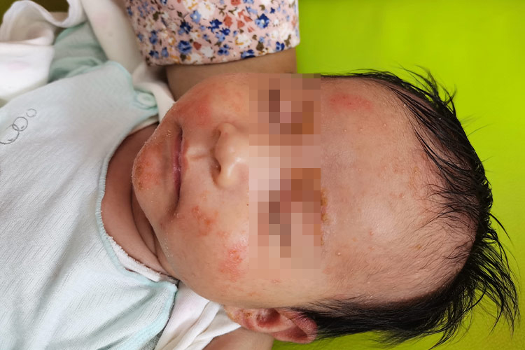 湿疹面部红疙瘩图 湿疹面部红疙瘩图