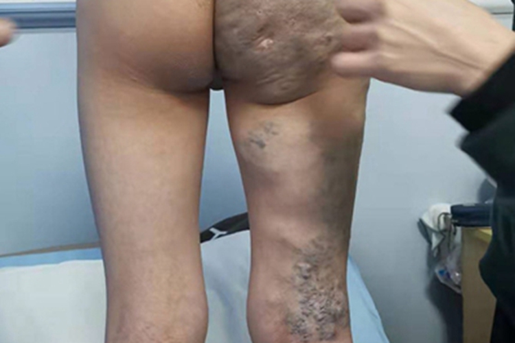 海绵状血管瘤腿皮肤发青图 海绵状血管瘤腿皮肤发青图