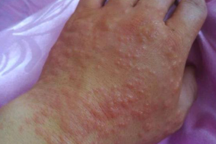 糖尿病患者湿疹图 糖尿病患者湿疹图