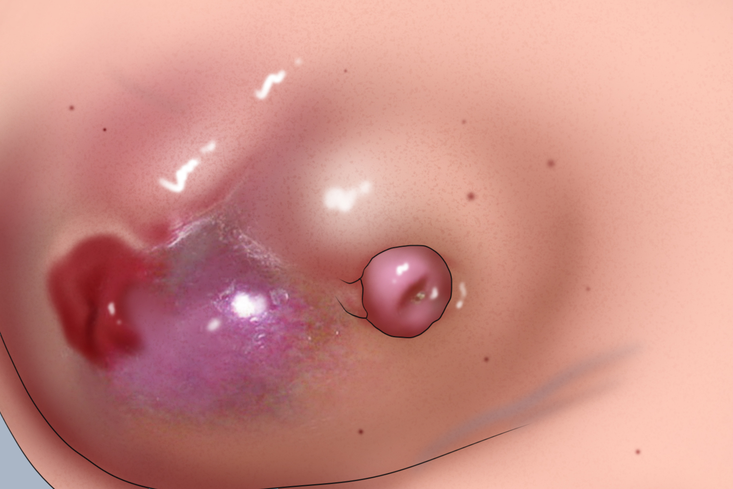 急性乳腺炎皮肤溃烂图