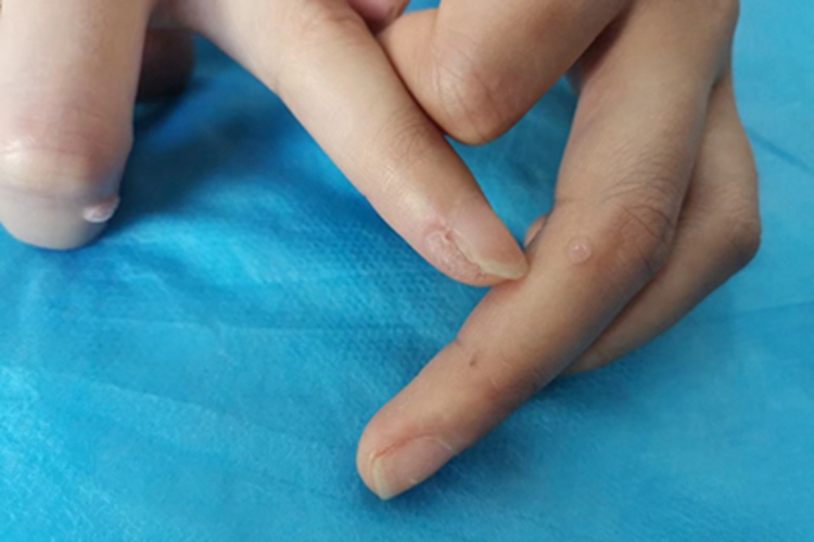 寻常疣手指上长硬包图 寻常疣手指上长硬包图