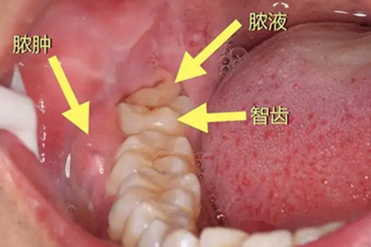 急性扩展型冠周炎牙龈症状图 急性扩展型冠周炎牙龈症状图