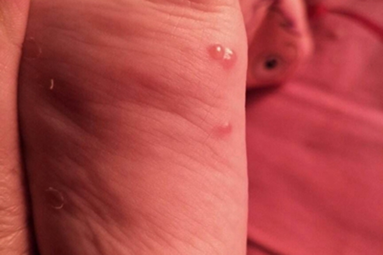 新生儿脓疱疮脚底水疱图