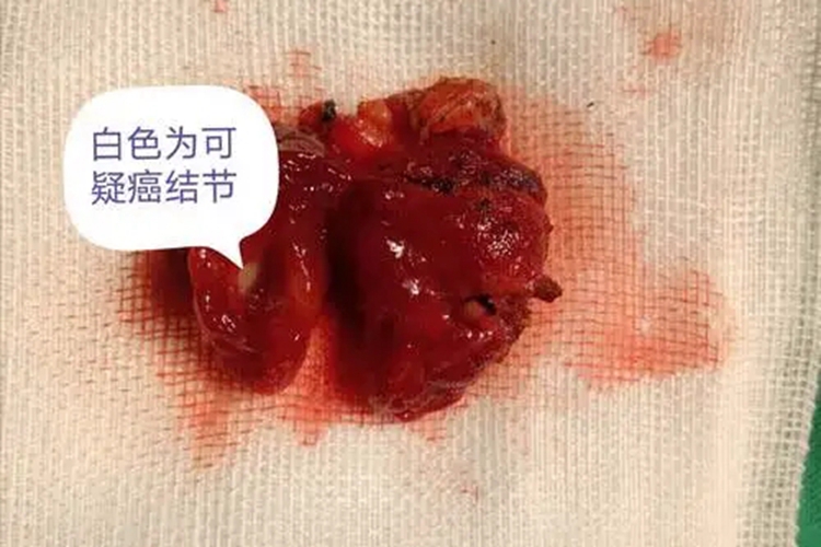 甲状腺乳头状癌切除结节图 甲状腺乳头状癌切除结节图