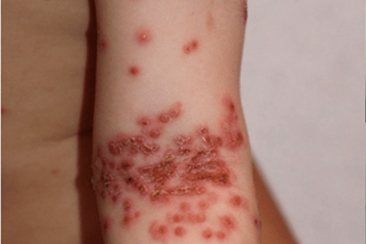 儿童期特应性皮炎小红疙瘩图