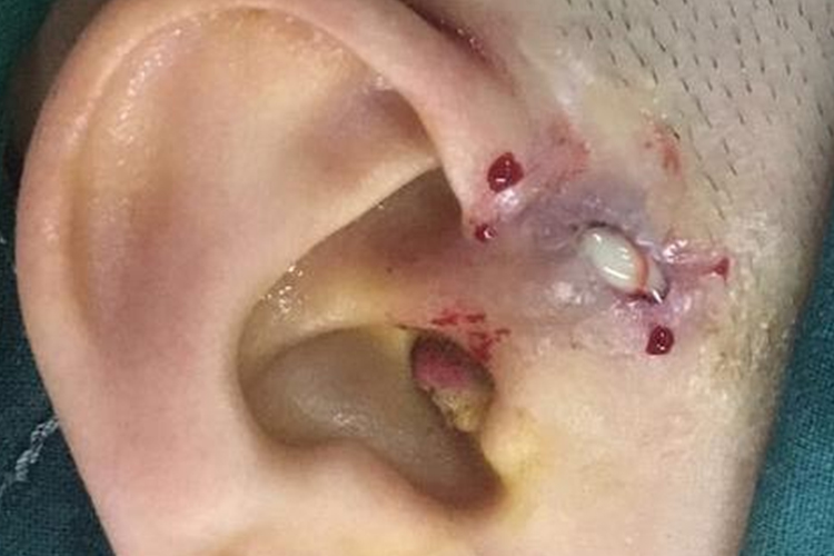 耳前瘘管流脓图