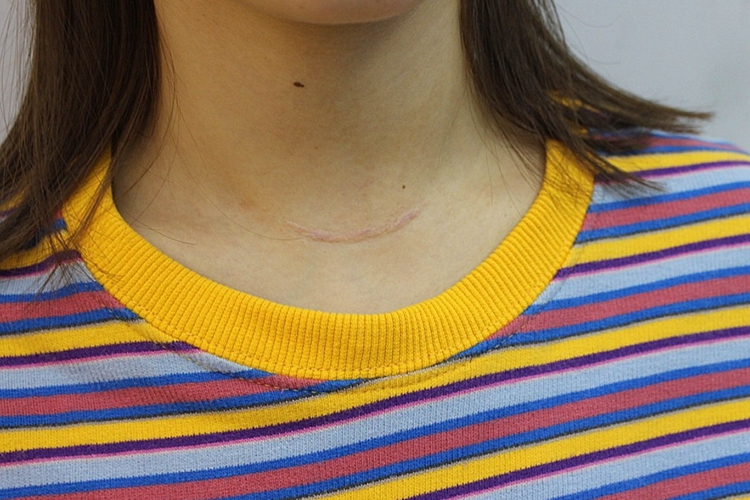 传统开放术式术后疤痕图