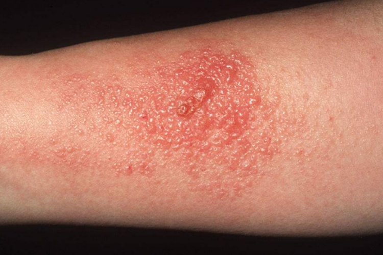 过敏起水疱图 过敏起水疱图