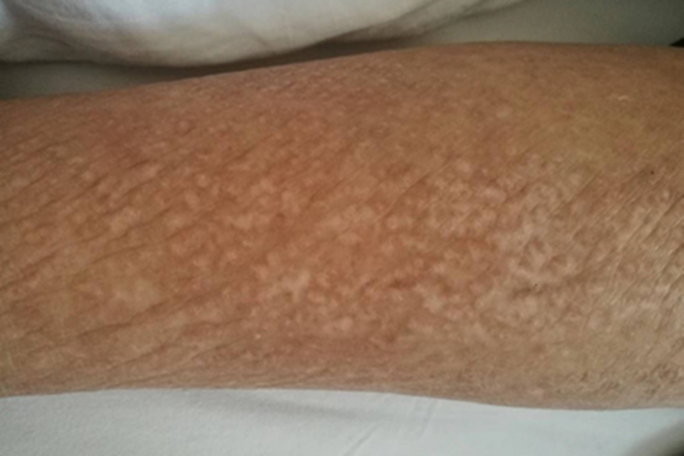 苔藓样淀粉样变病皮肤粗糙图
