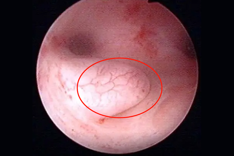 子宫息肉较大图
