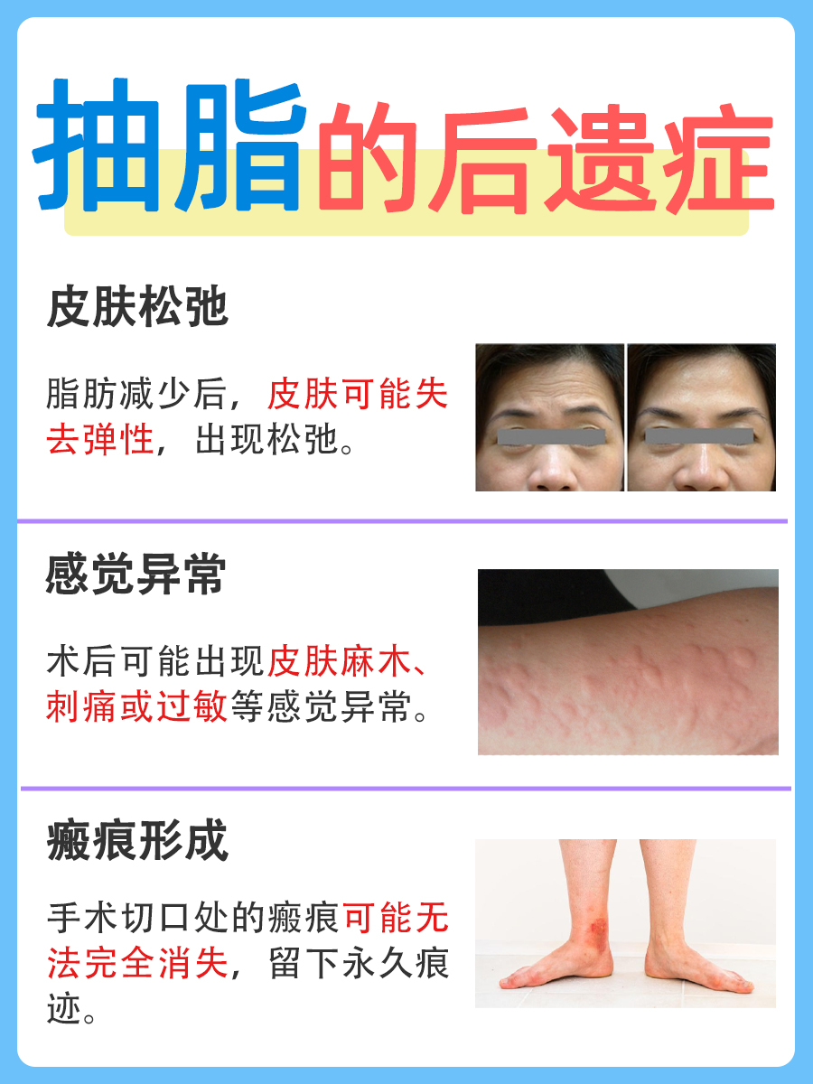 抽脂的风险和后遗症，快来了解！