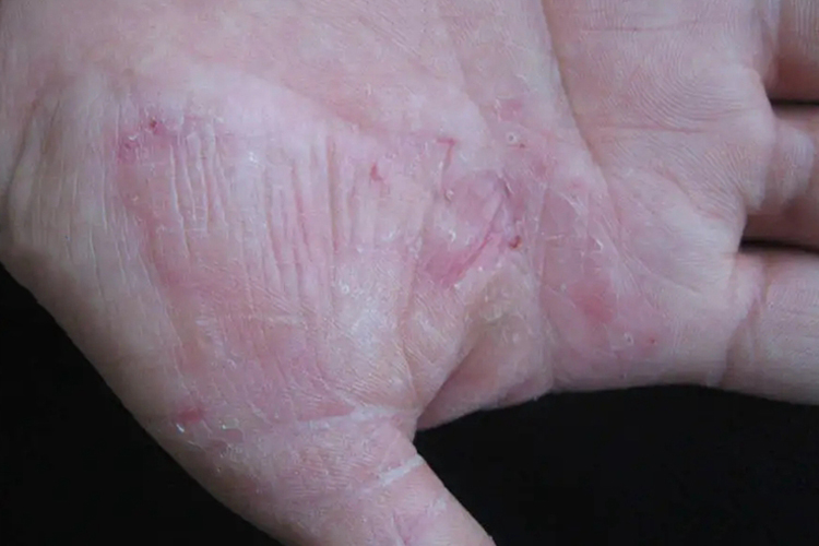 二期梅毒领圈样脱屑皮疹图