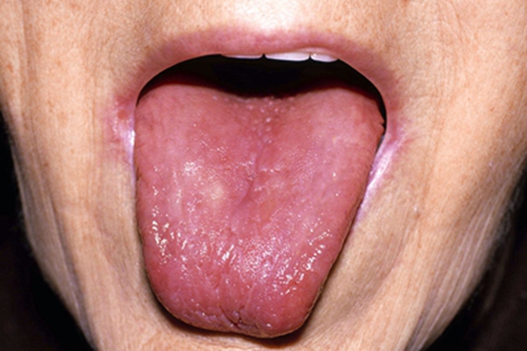 维生素B12缺乏症舌头症状图