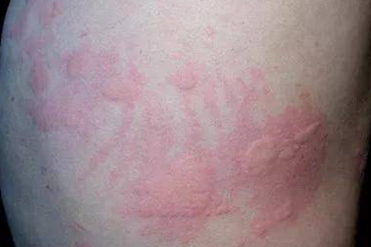 荨麻疹背部红斑图