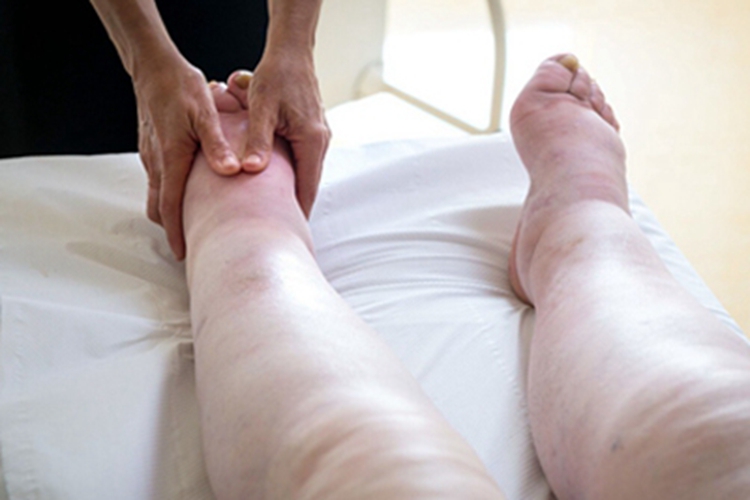 皮肤丝虫病小腿肿图