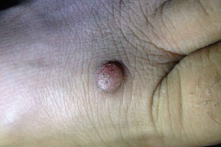 疣状皮肤结核脚背症状图 疣状皮肤结核脚背症状图