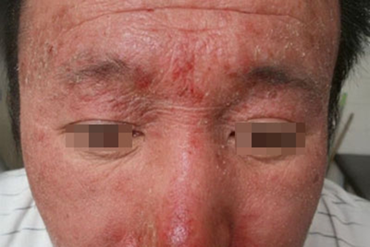 假性卟啉病面部红斑图