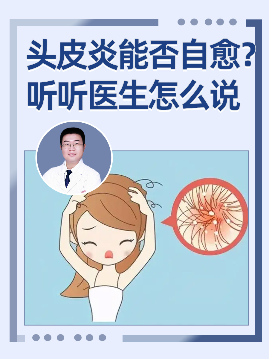 头皮炎能否自愈？听听医生怎么说