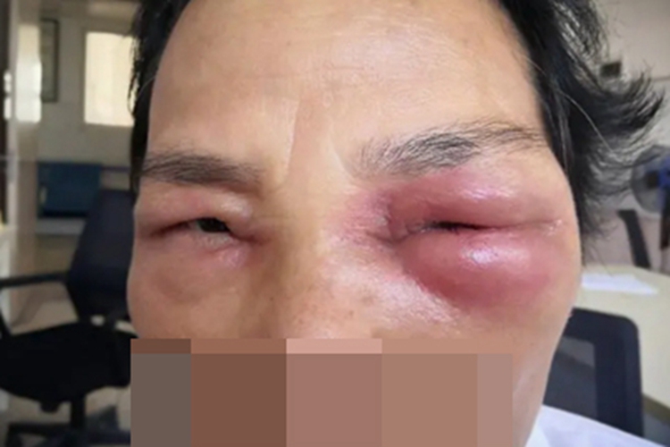 眶蜂窝织炎眼部红肿图 眶蜂窝织炎眼部红肿图