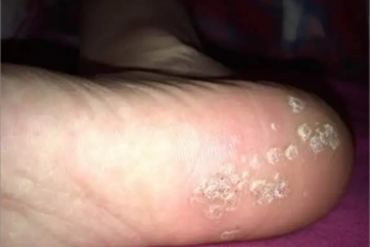 掌跖点状角化脚后跟脱屑图