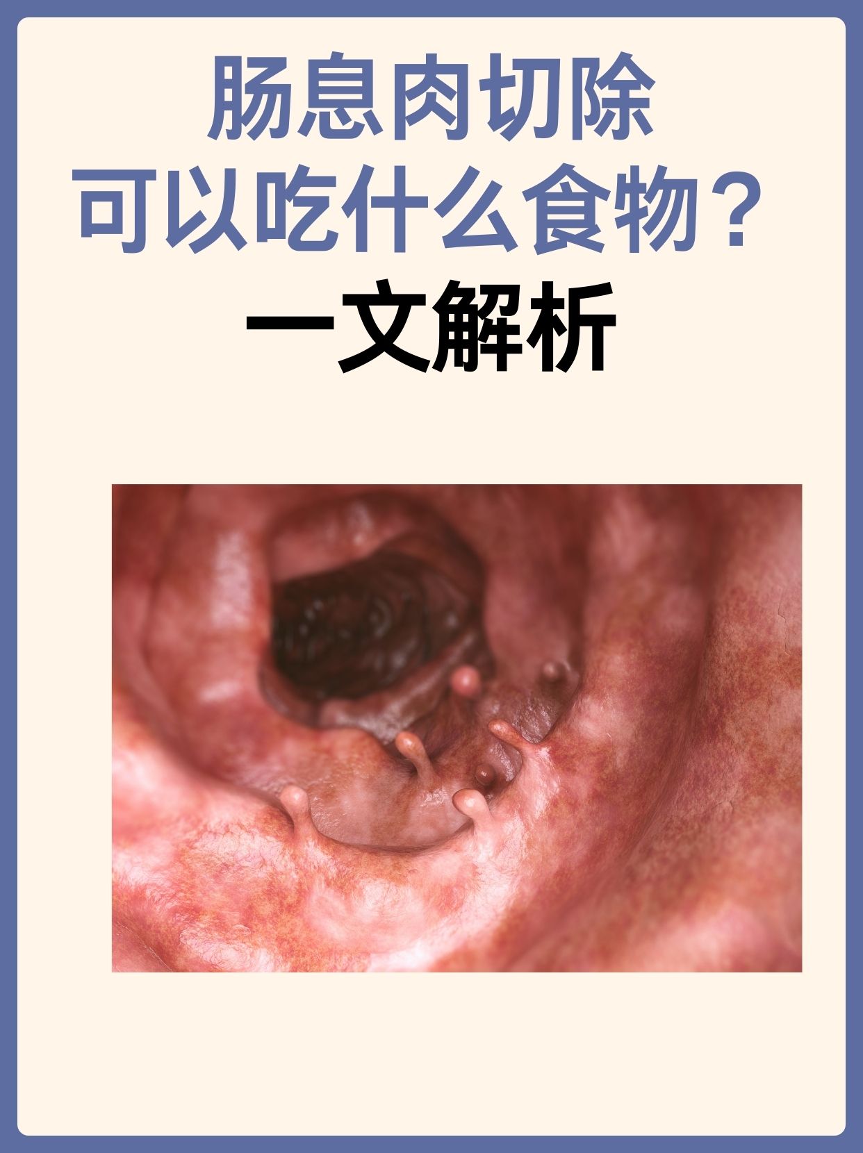 肠息肉切除，可以吃什么食物？一文解答