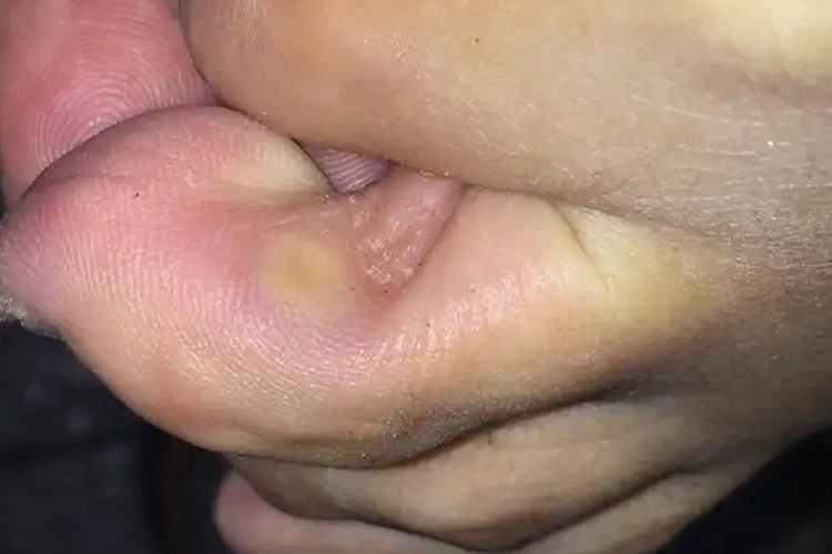脚趾缝胼胝图 脚趾缝胼胝图