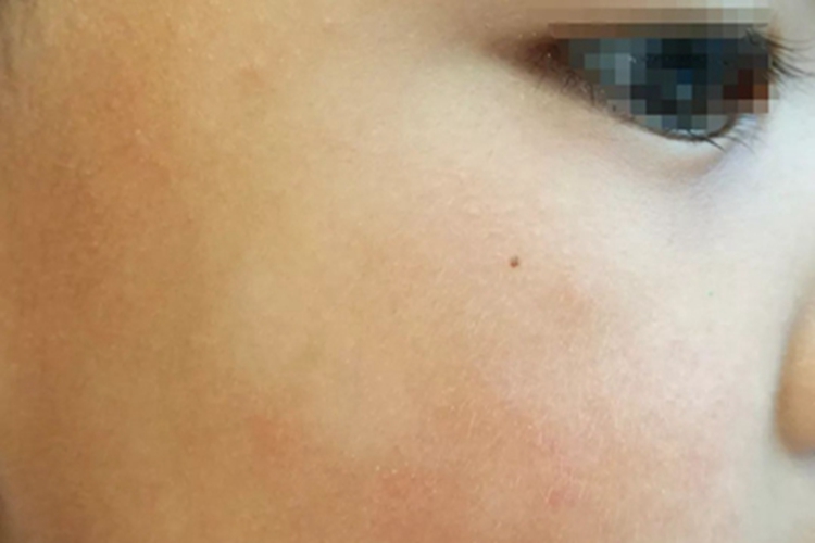 白色糠疹面部长多个白斑图