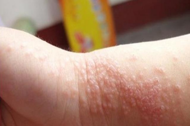 急性湿疹手腕图 急性湿疹手腕图
