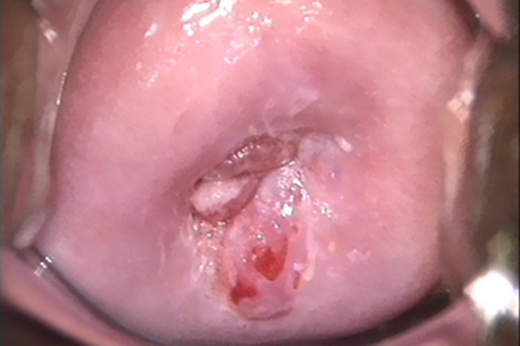 宫颈囊肿症状图