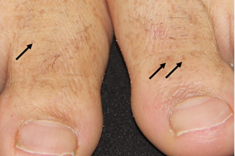 家族性进行性色素沉着症脚趾斑图