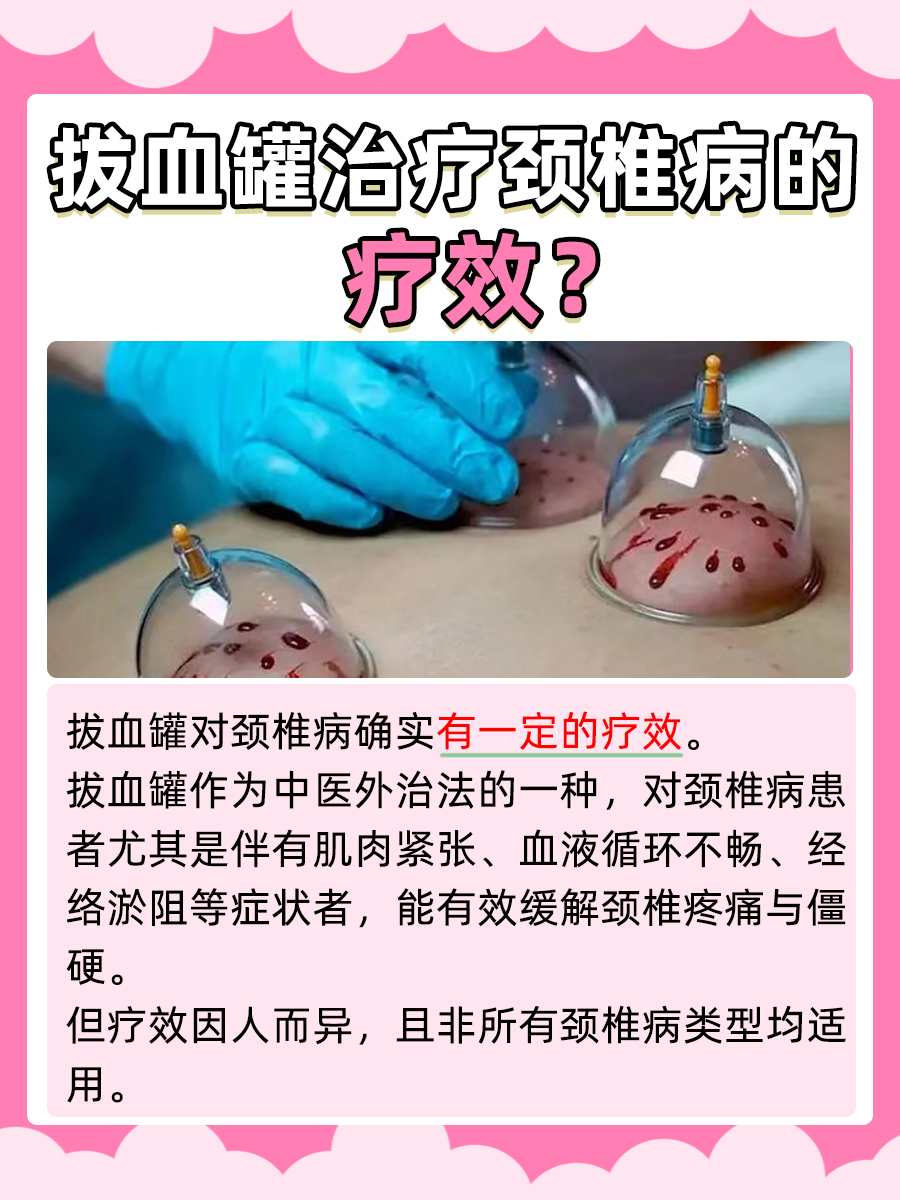 医生解析：拔血罐对颈椎病真的有疗效吗？