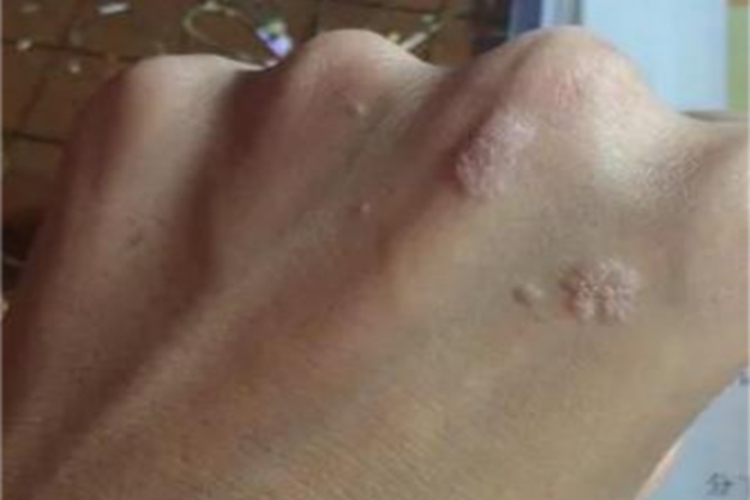 疣状表皮发育不良手背症状图