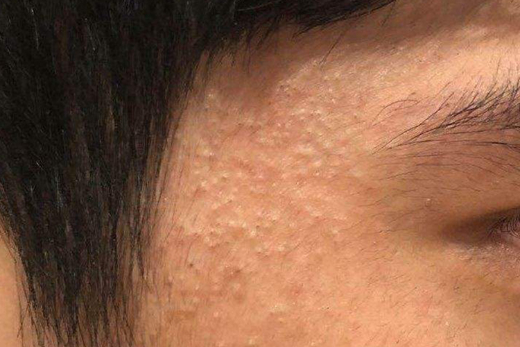 脸上白癣早期图