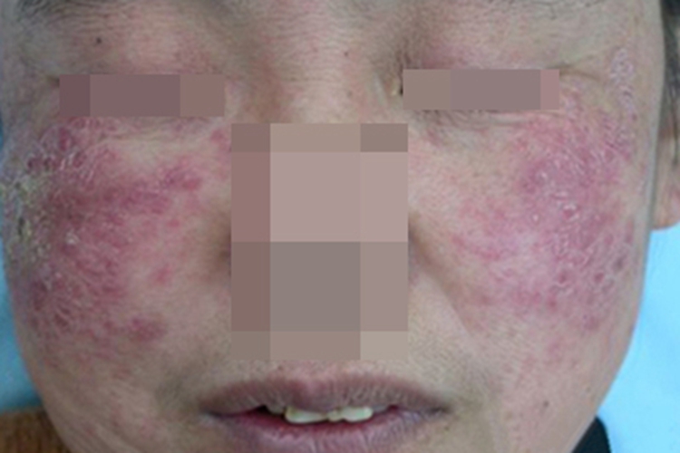 昆虫性皮炎面部脱皮图 昆虫性皮炎面部脱皮图