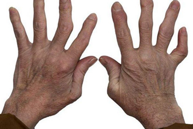 混合性结缔组织病手指僵硬图