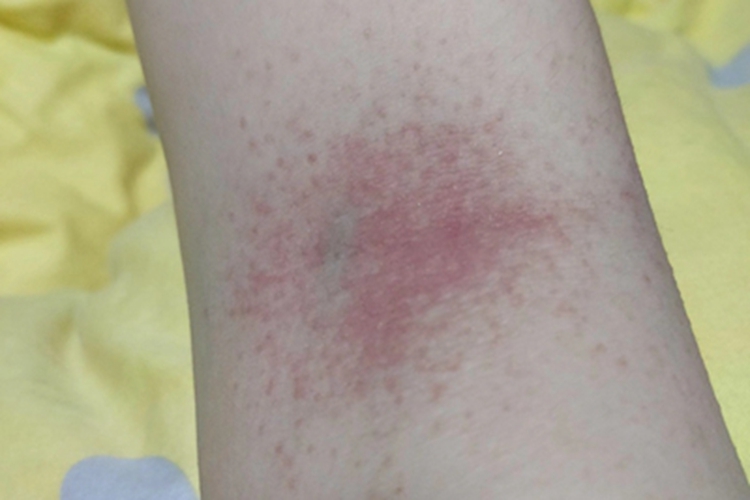 皮革皮炎手肘红点图