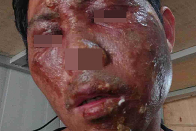 电烧伤面部红肿图 电烧伤面部红肿图