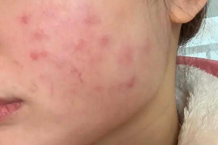 水光针过敏图 水光针过敏图