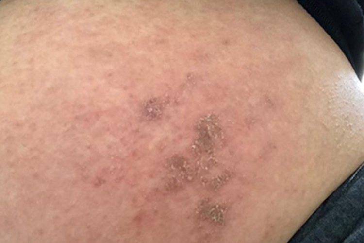 慢性湿疹腹部结痂图 慢性湿疹腹部结痂图