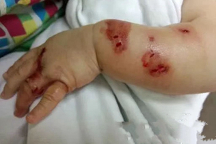 小螺菌型鼠咬热红斑图