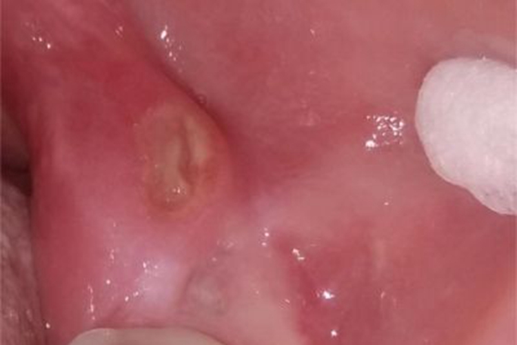 创伤性溃疡唇内侧症状图