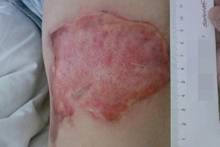 脂质渐进性坏死背部症状图 脂质渐进性坏死背部症状图